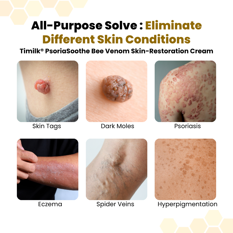 Timilk® PsoriaSoothe Bee Venom Skin-Restoration Cream 🔥