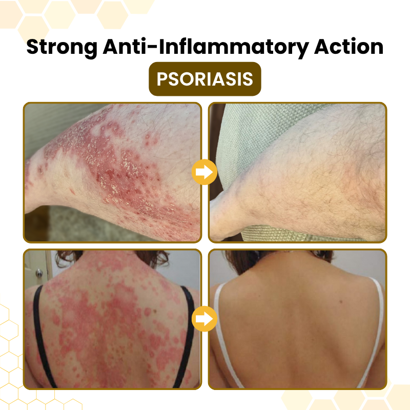 Timilk® PsoriaSoothe Bee Venom Skin-Restoration Cream 🔥