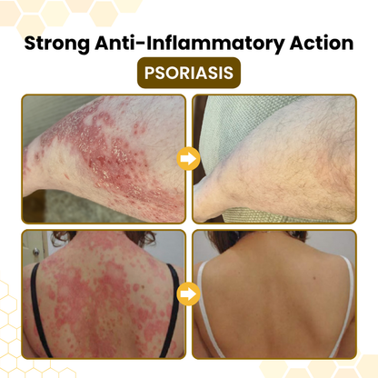 Timilk® PsoriaSoothe Bee Venom Skin-Restoration Cream 🔥